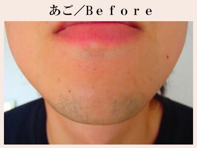 あごひげ脱毛Before