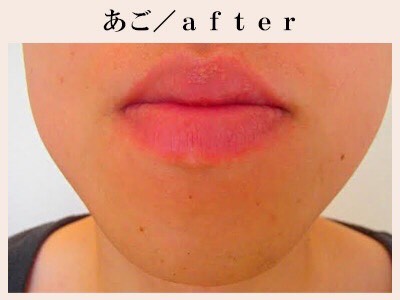 あごひげ脱毛After