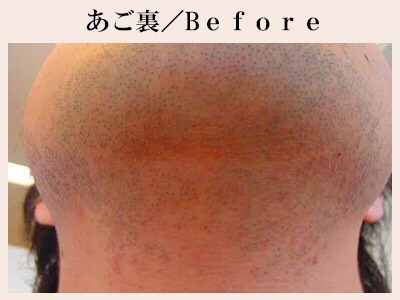 あご裏の脱毛前