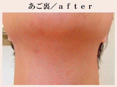 あご裏脱毛後