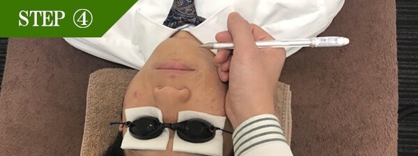 あご裏ヒゲ脱毛Step4