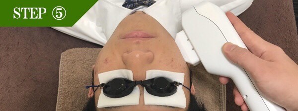 あご裏ヒゲ脱毛Step5