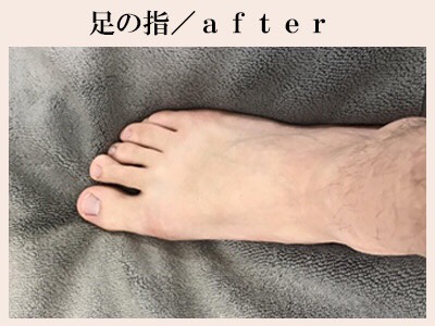 足の指脱毛後