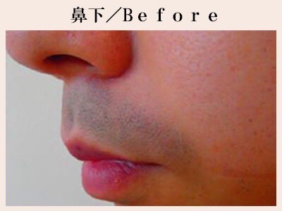 鼻下ヒゲ脱毛前