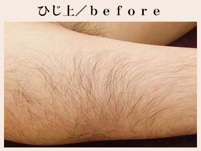 ひじ上の脱毛前