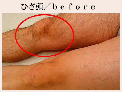 ひざ頭の脱毛前