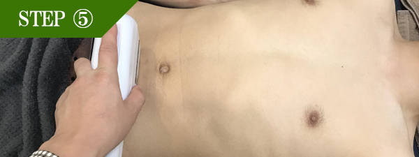 下腹部脱毛Step5