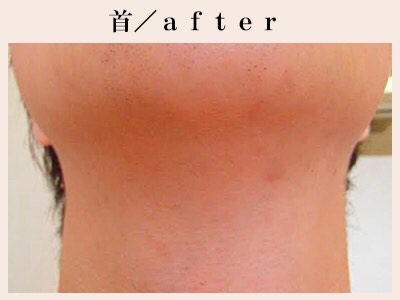 首脱毛後