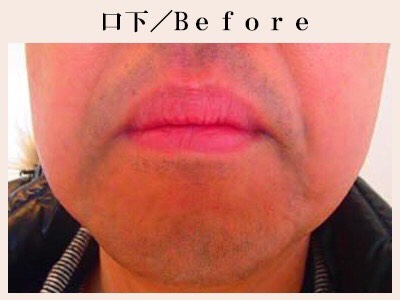 口下ヒゲ脱毛前