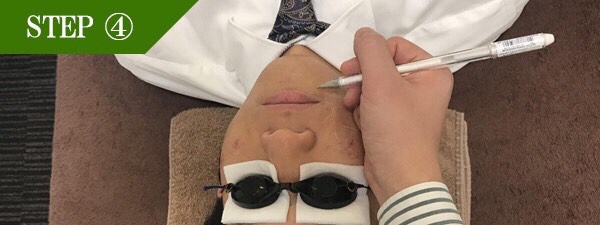 口下ヒゲ脱毛Step4