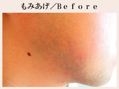 もみあげの脱毛前