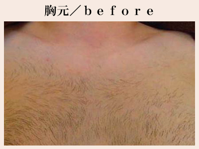胸元の脱毛前