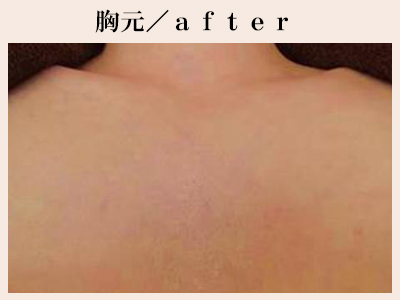 胸元の脱毛後