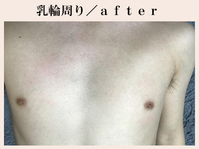 乳輪周り脱毛後