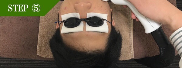 おでこ・眉間脱毛Step5